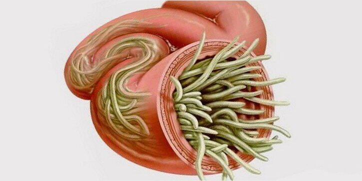 worms in the intestines