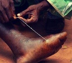 Parasite in the foot of a person